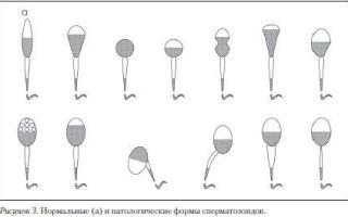 Спермограмма: сущность диагностической процедуры, ее проведение и расшифровка полученных результатов
