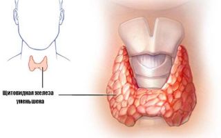 Уменьшение щитовидной железы: причины, симптомы и принципы питания