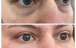 Применение бадяги от синяков под глазами в терапевтических и косметических целях