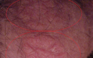 Шелушится кожа на яичках: заболевания, диагностика и лечение
