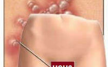 Высыпания на половых губах — основные причины появления и лечение