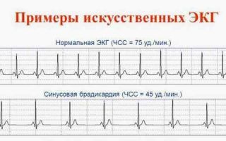 Умеренная синусовая брадикардия у детей и взрослых: возможные причины, признаки и методы лечения