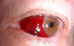 Лечение кровоизлияния в глаз — причины патологии, возможные заболевания, терапевтические мероприятия