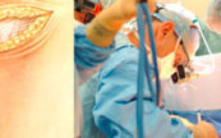 Сущность патологии варикоцеле, восстановление после операции