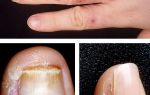 Сухая кожа на пальцах рук — в чем причины и как бороться с проблемой