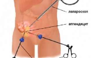 Где расположен аппендикс, для чего он нужен и как воспаляется: подробные ответы на вопросы