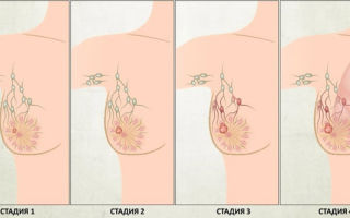 Онкологии грудной железы: симптомы, общие и особые признаки
