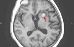 Каковы первые признаки опухоли головного мозга, причины возникновения, необходимое лечение