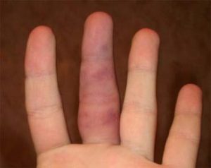Как разрабатывать палец после перелома - примеры для самостоятельного выполнения