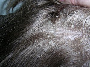 Себорея волосистой части головы: лечение, диагностирование, симптоматика и профилактика