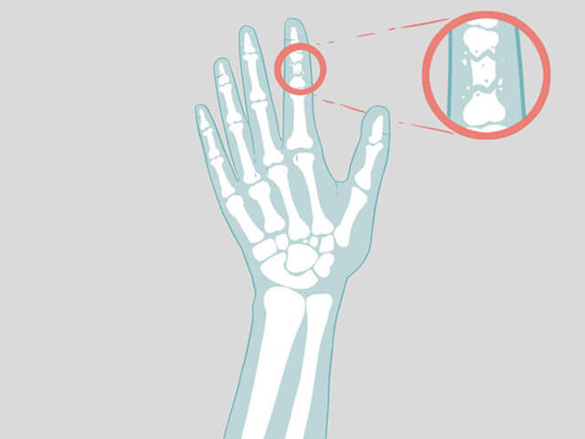 Как разрабатывать палец после перелома - примеры для самостоятельного выполнения