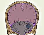 Симптомы опухоли мозжечка - описание болезни, клинические проявления, методы диагностики и лечения
