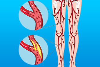 Симптомы заболевания сосудов ног, причины и механизм развития, диагностика, лечение и профилактика