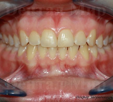 Выпал передний зуб, что делать: возможные причины и способы восстановления