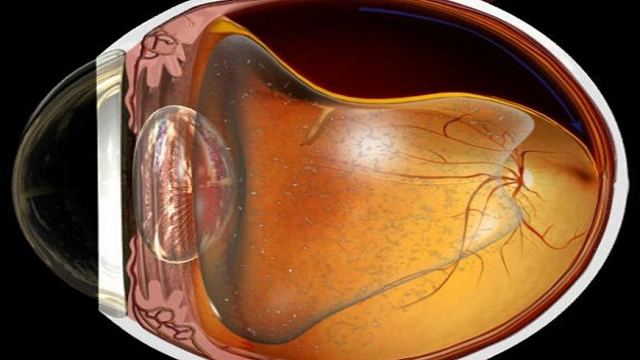 Истончение сетчатки глаза: причины возникновения, симптоматика по разновидностям, методы лечения