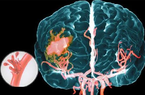 Кровоизлияние в мозг: последствия, причины развития и симптомы заболевания