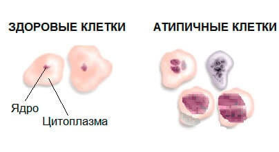 Клетки шейки матки. Атипичные эпителиальные клетки. Цитологическое исследование на атипические клетки. Атипия клеток плоского эпителия шейки матки. Атипичность раковой клетки.