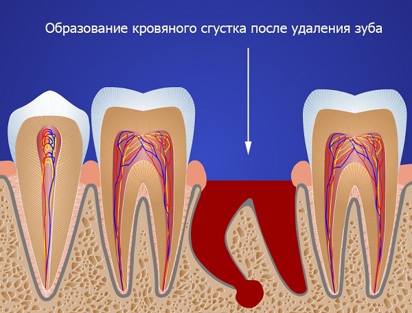 Чем можно полоскать рот после удаления зуба – рекомендации и рецепты от бывалых
