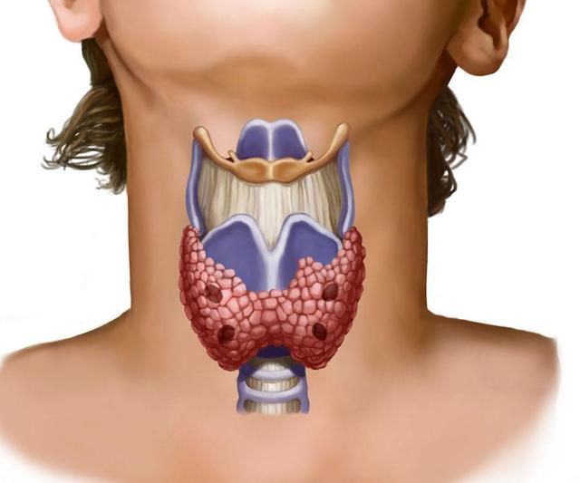 Щитовидная железа удалена: последствия для организма после операции