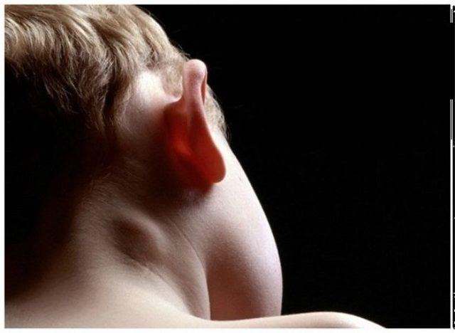 Увеличенный лимфоузел на шее у ребенка – как правильно лечить