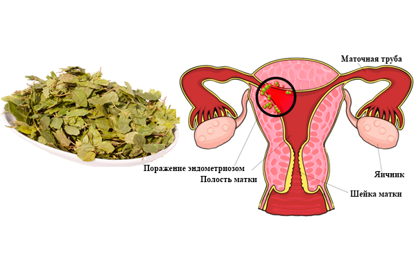 Народное лечение эндометриоза матки. Эндометриоз народные средства. Таблетки от эндометриоза матки.