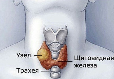 Щитовидная железа удалена: последствия для организма после операции