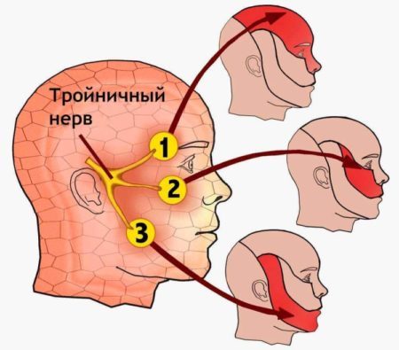 Неврит тройничного нерва: симптомы, проявления и осложнения