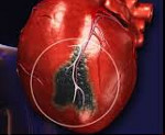 От чего бывает инфаркт: причины, клинические проявления, специфика лечения