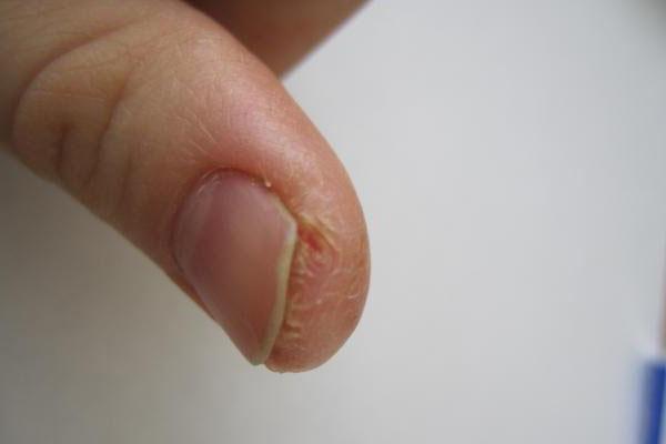 Почему трескается кожа на пальцах: правильный уход за кожей