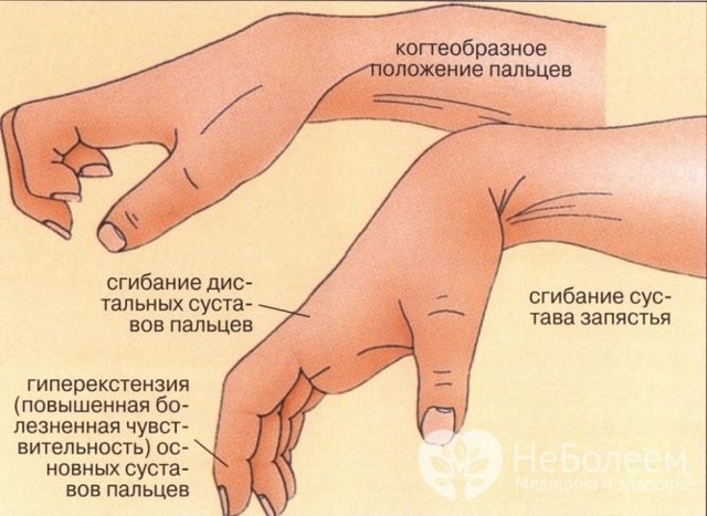 Первая помощь при ушибе руки: симптомы, народная и медикаментозная терапия, пошаговая инструкция
