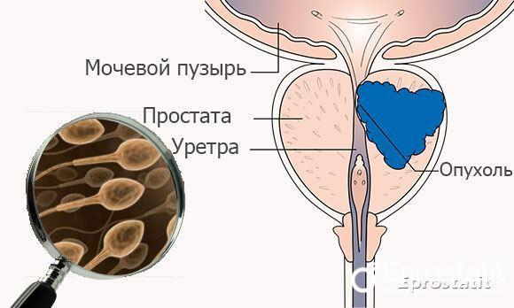 Сперма коричневого цвета - причины, возможные заболевания и их признаки, методы лечения