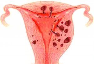 Можно ли забеременеть при эндометриозе матки: причины заболевания и его влияние на репродуктивные функции