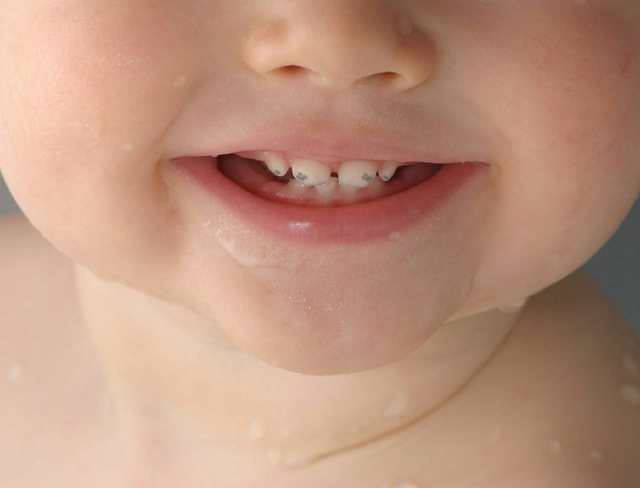 Почему у ребенка черный налет на зубах: причины и лечение