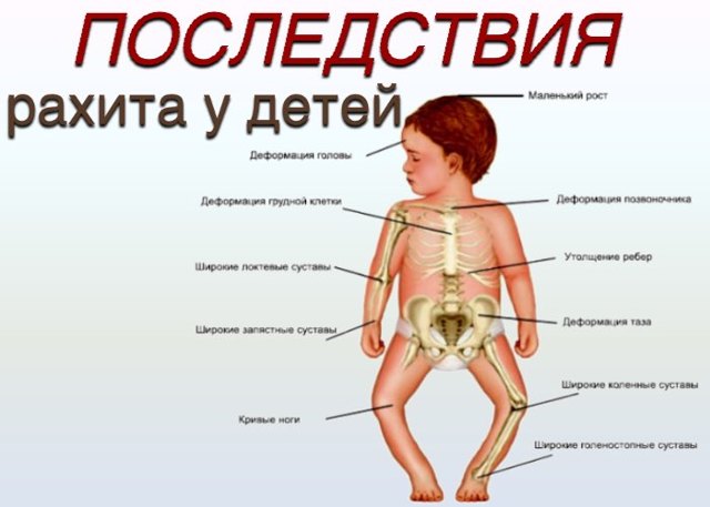 Симптомы рахита у детей - основные проявления болезни, причины и виды патологии, диагностика, лечение