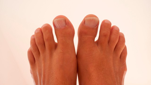 Почему появляются пузырьки на пальцах ног и как от них избавиться