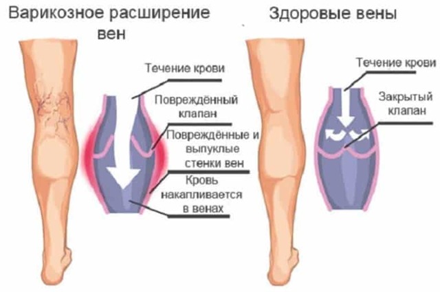 Симптомы заболевания сосудов ног, причины и механизм развития, диагностика, лечение и профилактика