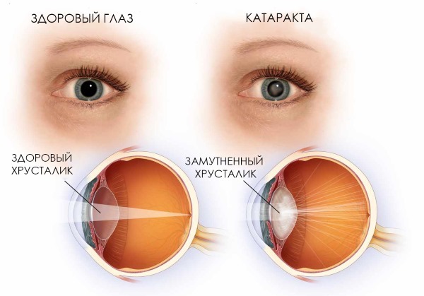 Лечение катаракты медом: самые эффективные народные рецепты