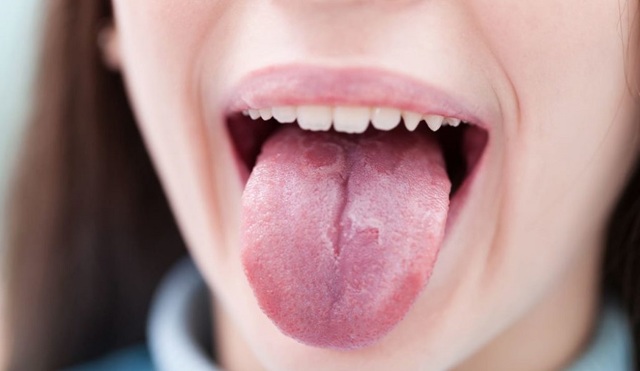 Как убрать налет на языке в домашних условиях без лекарств