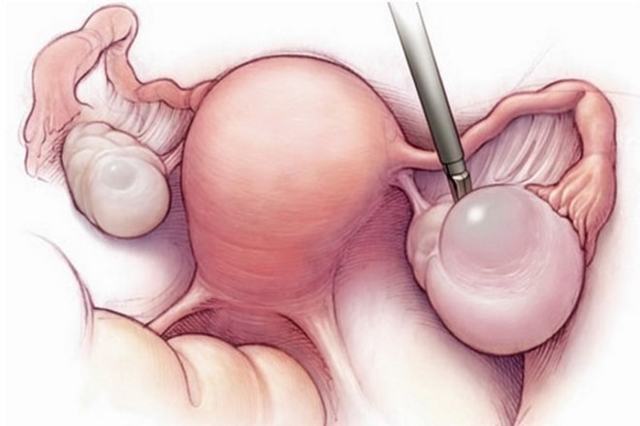 Для чего проводится резекция яичника – последствия и принцип операции