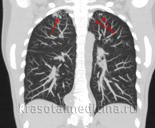 Туберкулез позвоночника: симптомы, лечение и способы диагностики