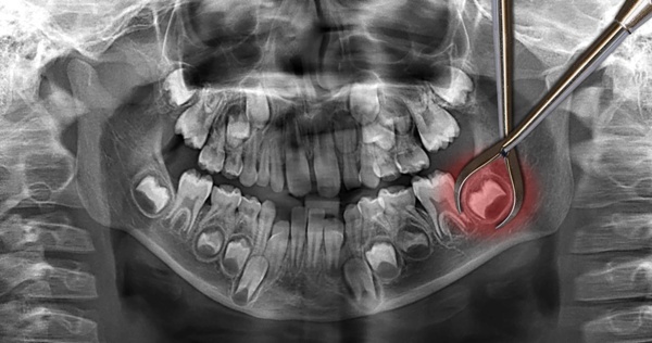 Больно ли вырывать зуб мудрости: симптомы роста, возможные патологии, методы лечения и реабилитации