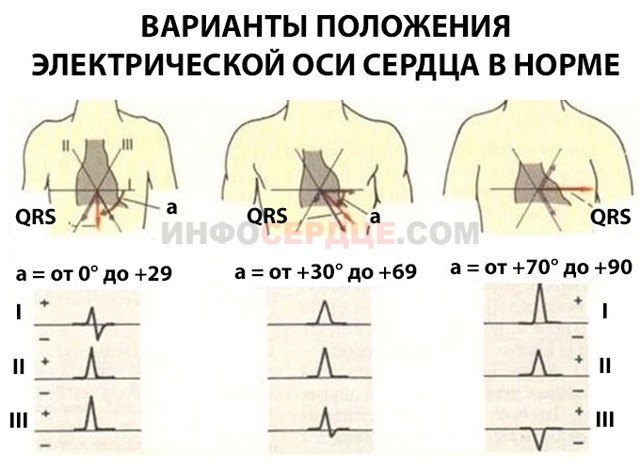 Отклонение электрической оси сердца вправо: признаки