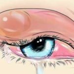 Как лечить ячмень под глазом: медикаментозные, народные методы лечения, симптомы и причины развития