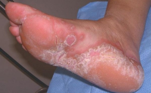 Лечение микоза  кожи медикаментозными и народными методами
