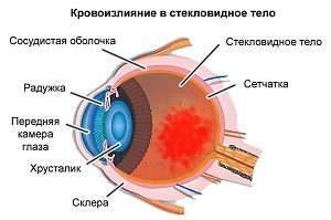 Лечение кровоизлияния в глаз - причины патологии, возможные заболевания, терапевтические мероприятия
