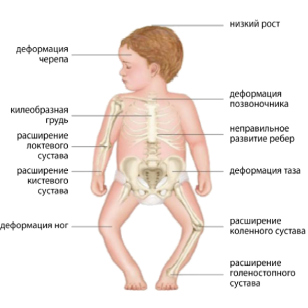 Симптомы рахита у детей - основные проявления болезни, причины и виды патологии, диагностика, лечение