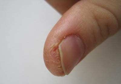 Почему трескаются пальцы на руках - что делать в плане лечения и профилактики