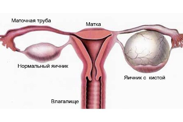 Киста яичника в менопаузе: причина развития, методы лечения