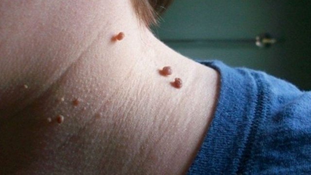 Лечение папиллом на коже: самые распространенные способы