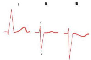 Отклонение электрической оси сердца вправо: признаки